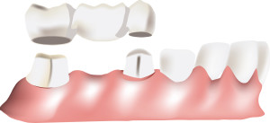 ponte dentale 1
